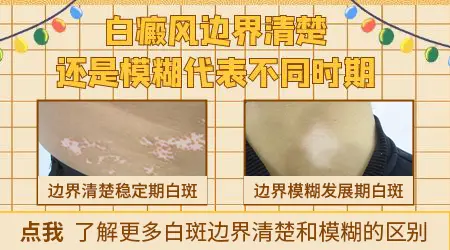 白斑边界清晰和模糊分别代表什么