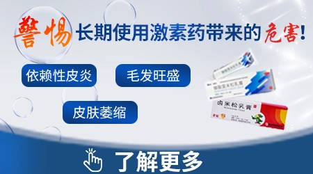 白癜风外用激素软膏多久会出副作用