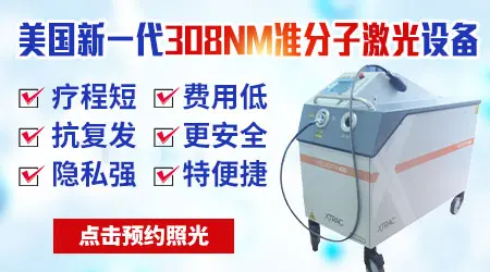 眼部白癜风能照窄谱紫外线吗有没有辐射