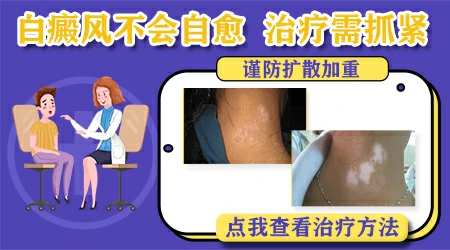 黑色素缺失引起的白斑能自愈吗