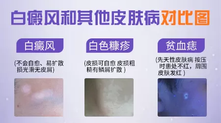 轻度白癜风与其他白斑病症状有什么区别