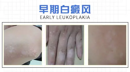白癜风早期有什么症状图片