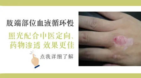 胳膊白斑做光疗多久能看到效果