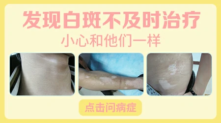 腿上成片白斑是怎么回事