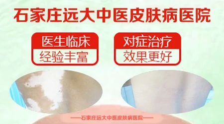 腿上成片白斑是怎么回事