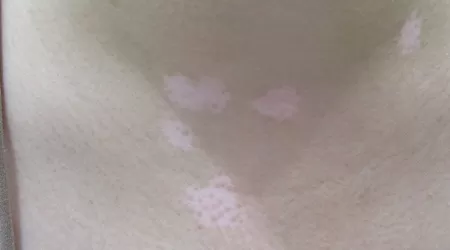 脖子上长白斑是什么情况