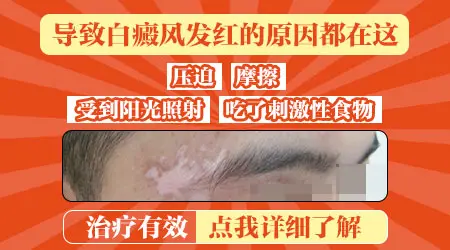 白癜风处皮肤变红是怎么回事