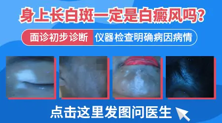 肛周白斑一定是白癜风吗 怎么区分