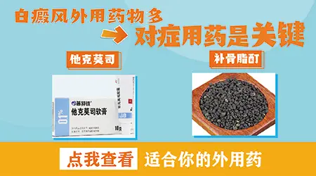 白癜风外用药膏推荐哪个效果好