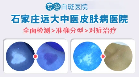 嘴角边上有白斑图片 什么原因引起的