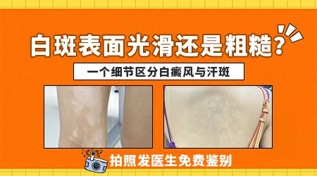 汗斑和白癜风怎么肉眼区分图片