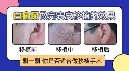 白癜风做表皮移植手术有什么风险