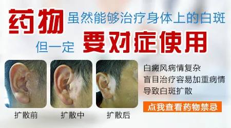 还不确定是不是白癜风能用药吗