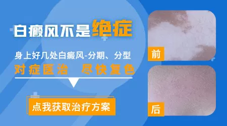 儿童白斑初期图片是什么样的