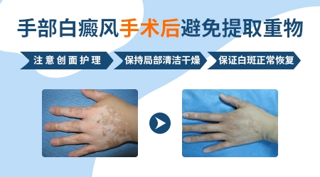 手部白癜风为什么难治 有什么特殊治疗方法