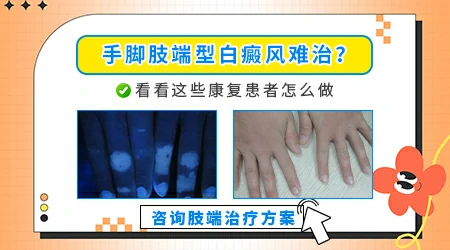 为什么手上白癜风很难治好