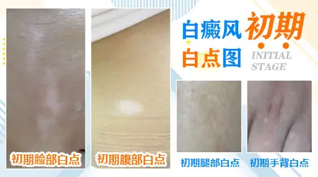 大腿上有一小块皮肤发白怎么回事