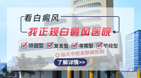 女性面部轻度白癜风早期图片