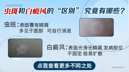 儿童脸上白斑是白癜风还是虫斑