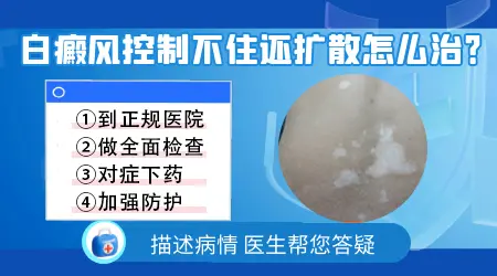 白癜风一直扩散控制不住怎么办