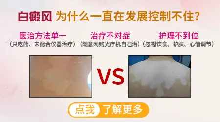 白癜风一直扩散控制不住怎么办