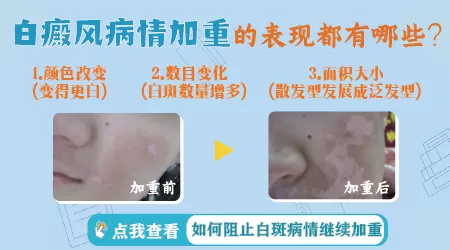 白斑颜色越来越白是严重了吗