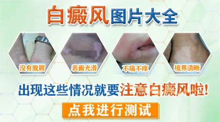 白斑边界清晰是哪种皮肤病