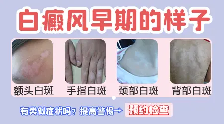 白癜风是什么样子的 能摸出来吗