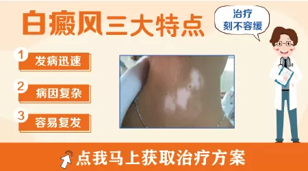 白癜风是什么样子的 能摸出来吗