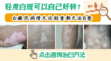 白癜风早期症状轻有没有自愈的方法