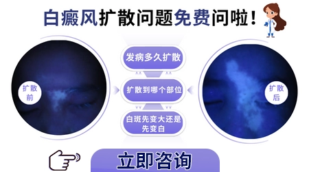 白癜风白斑从淡白色变成乳白色是严重了吗