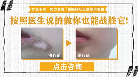 医生说疑似白癜风不能确诊怎么办