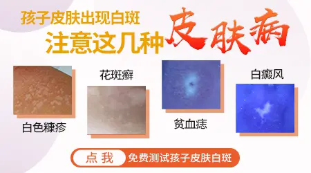 小孩脸上长白癜风早期什么样图片
