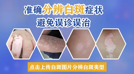 初期白癜风有哪些明显症状