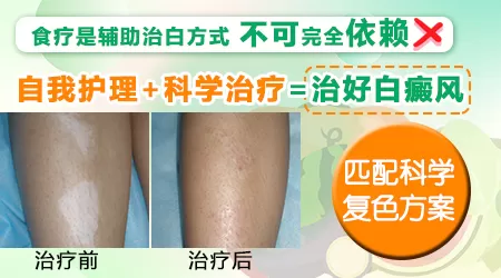 白癜风平常吃什么有助于快速补充黑色素