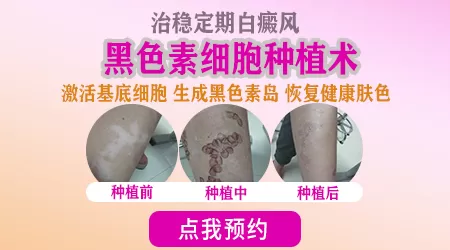 白癜风什么情况下适合做手术