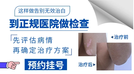 伍德灯检查白斑和花斑癣的荧光有什么区别