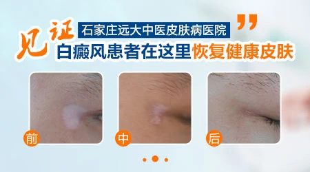 孩子臀部长淡白斑块是什么问题