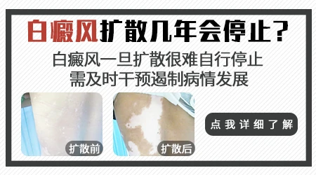 白癜风扩散一般多久停止