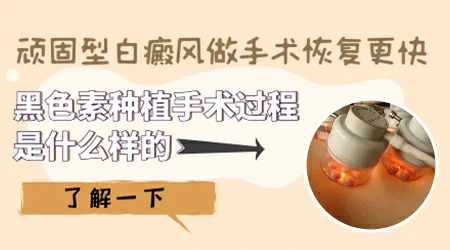 什么情况下白癜风考虑手术治疗