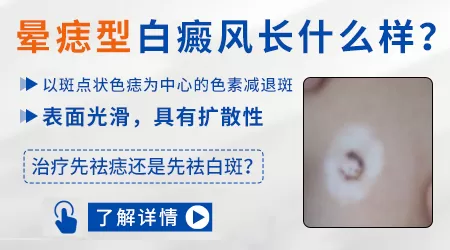 晕痣型白癜风图片是什么样子的