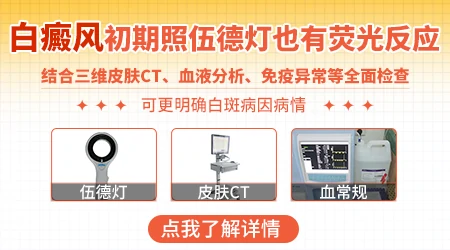 白癜风早期在伍德灯下是什么样子