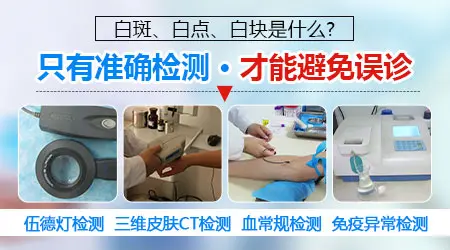 白癜风和白色糠疹、花斑癣怎么区分