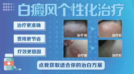 只做伍德灯不做皮肤CT会不会误诊白癜风