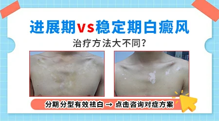 怎么判断自己白斑是进展期还是稳定期
