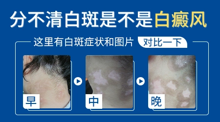 各种类型白斑的区别图片大全
