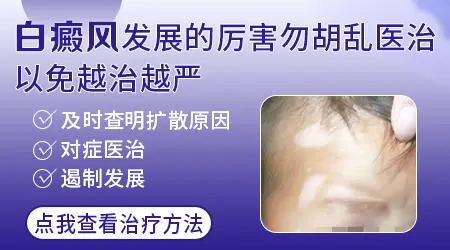 白癜风扩散时有什么征兆
