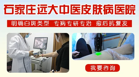 石家庄远大中医皮肤病医院能治好白癜风吗