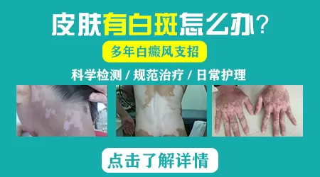 白癜风和贫血痣要怎么鉴别图片