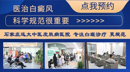 石家庄本地有哪些医院的皮肤科擅长看白癜风